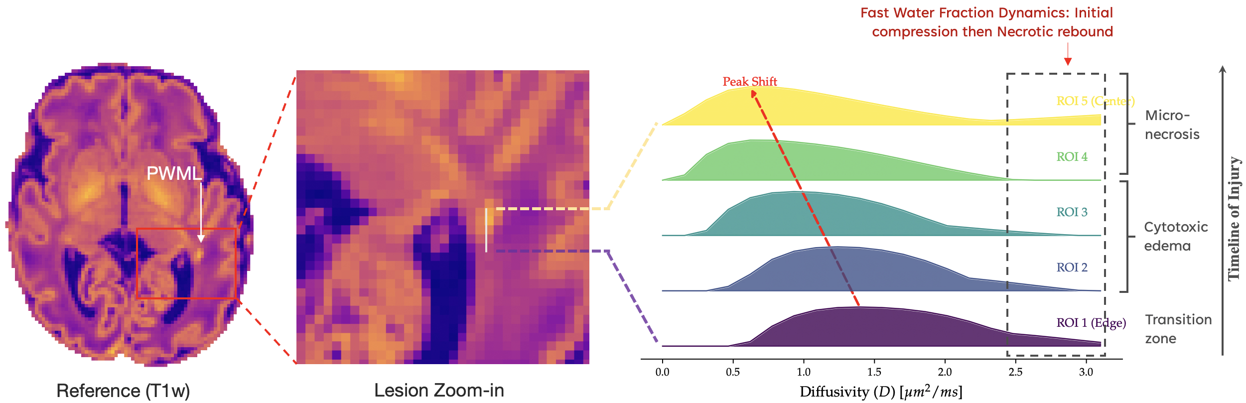 SDBM resolving microstructural gradients in neonatal PWML